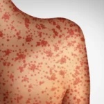 someone with signs of measles